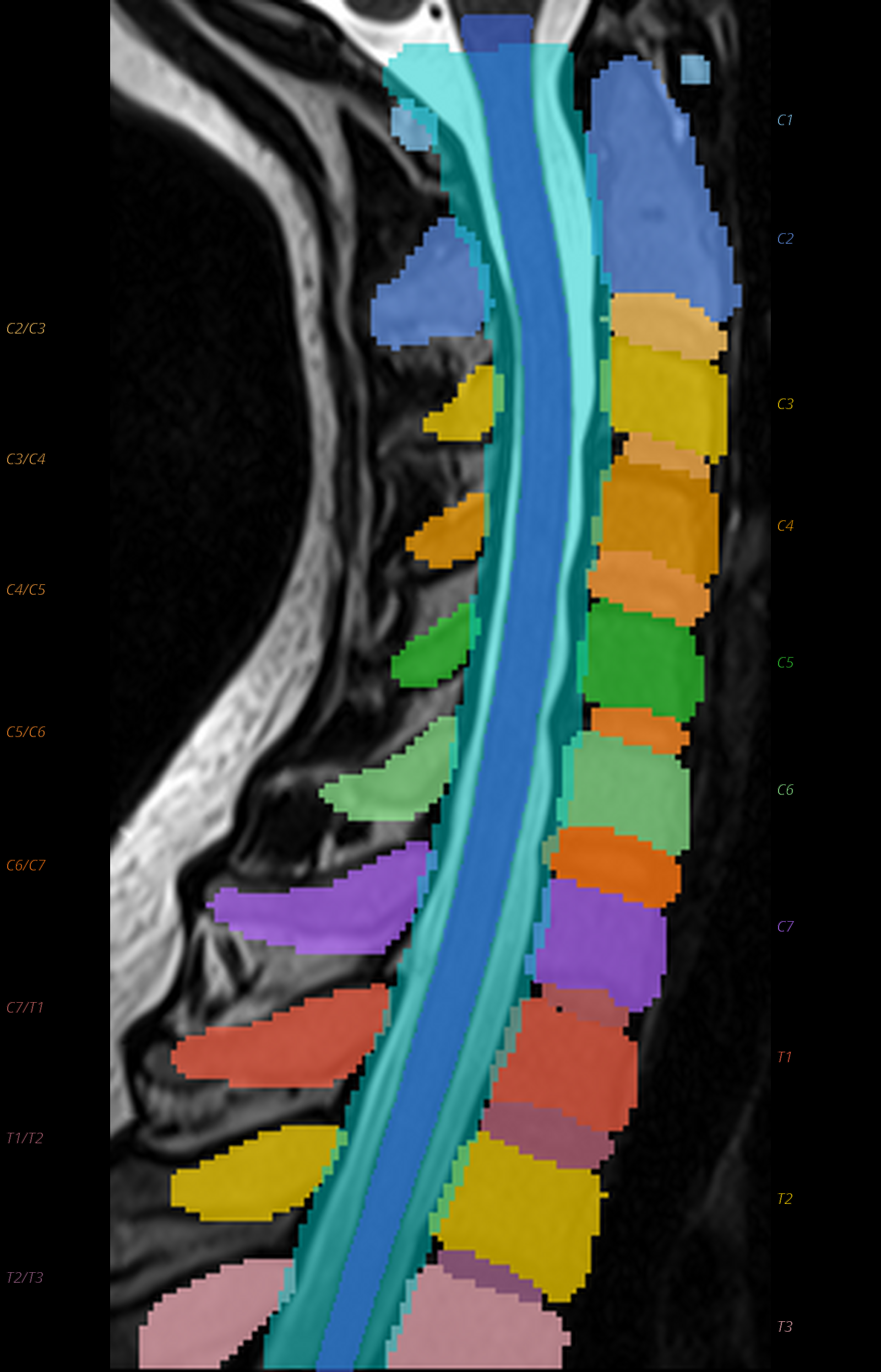 SpinePrep S2.2 reportlet: sagittal spinal cord with TotalSpineSeg vertebrae and disc labels